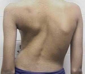 escoliose como causa de dor nas costas