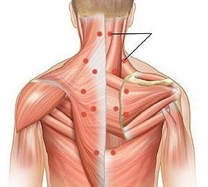 miosite como causa de dor nas costas