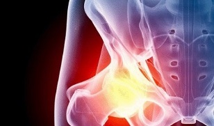 causas do desenvolvimento de artrose do quadril