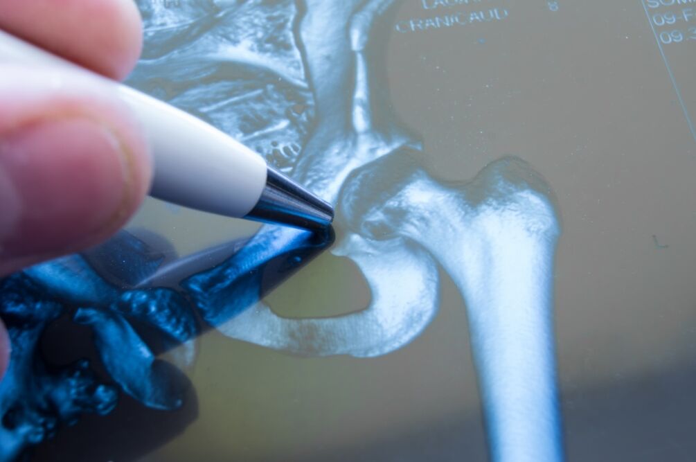 Artrose da articulação do quadril na radiografia