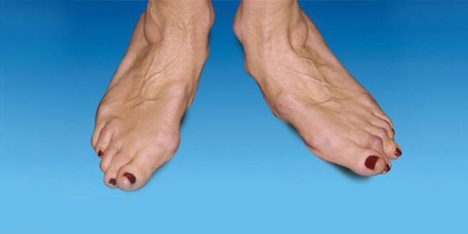 deformidade do pé com artrose do tornozelo