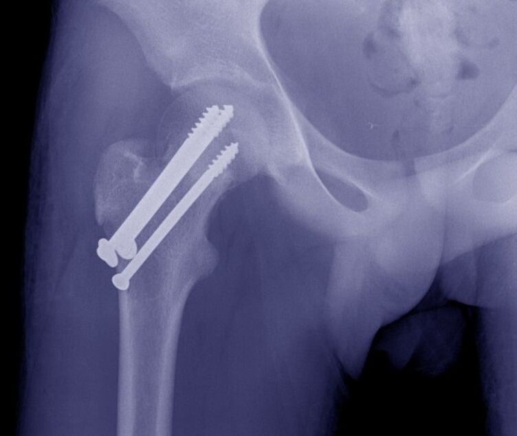 Raio-X da articulação do quadril, osteossíntese da fratura com dispositivos de fixação interna