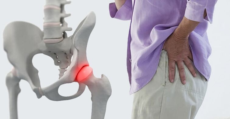 dor na região do quadril - um sintoma de artrose da articulação do quadril