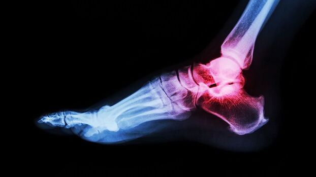 artrose de tornozelo