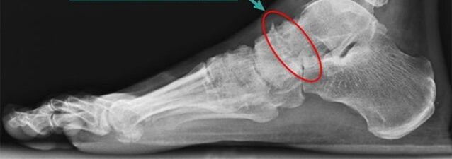 cintilografia para artrose do tornozelo