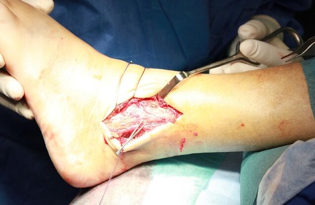 cirurgia para artrose do tornozelo