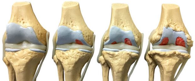 dano articular em diferentes estágios de desenvolvimento da artrose do tornozelo