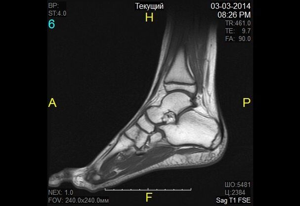 imagem do tornozelo para artrose