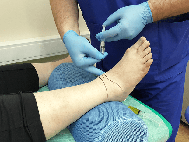 punção para artrose da articulação do tornozelo