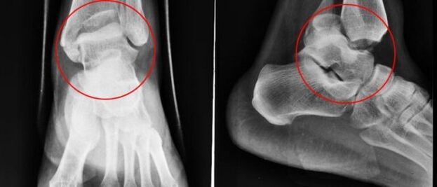 radiografia para artrose do tornozelo