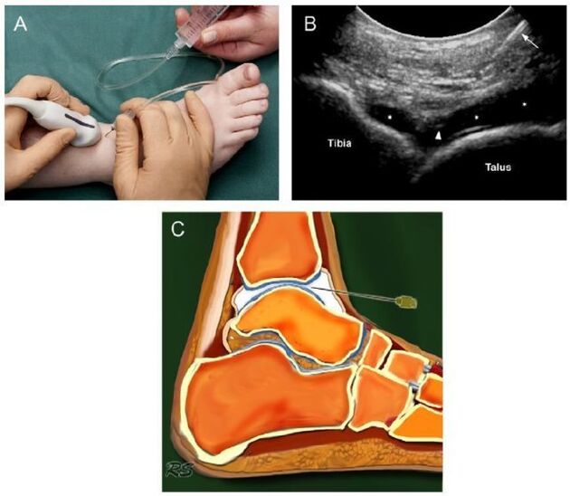 ultrassom da articulação do tornozelo com artrose
