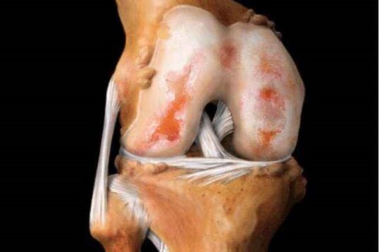 dano à articulação do joelho com artrose