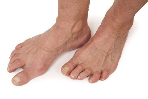 pés afetados por artrose