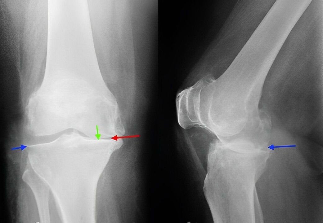 radiografia de artrose da articulação do joelho