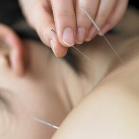 Acupuntura