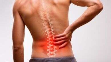 Sinais e sintomas de osteocondrose da coluna lombar