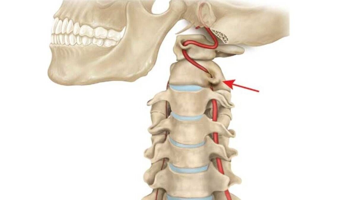 osteocondrose da coluna cervical