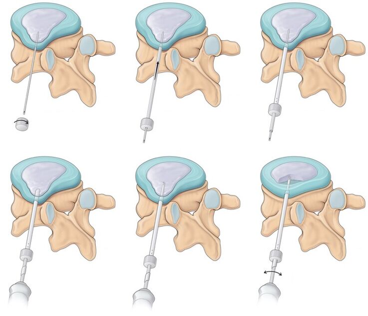 cirurgia para dor nas costas